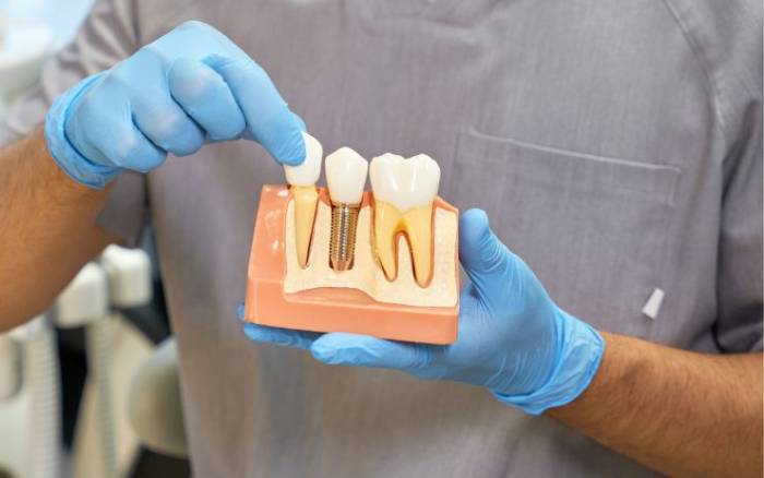 Dental Implant Treatment In Agra